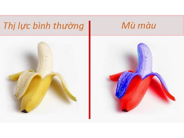 Tìm hiểu về bệnh mù màu, nguyên nhân và cách chữa trị